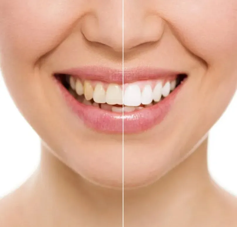 Teeth Whitening